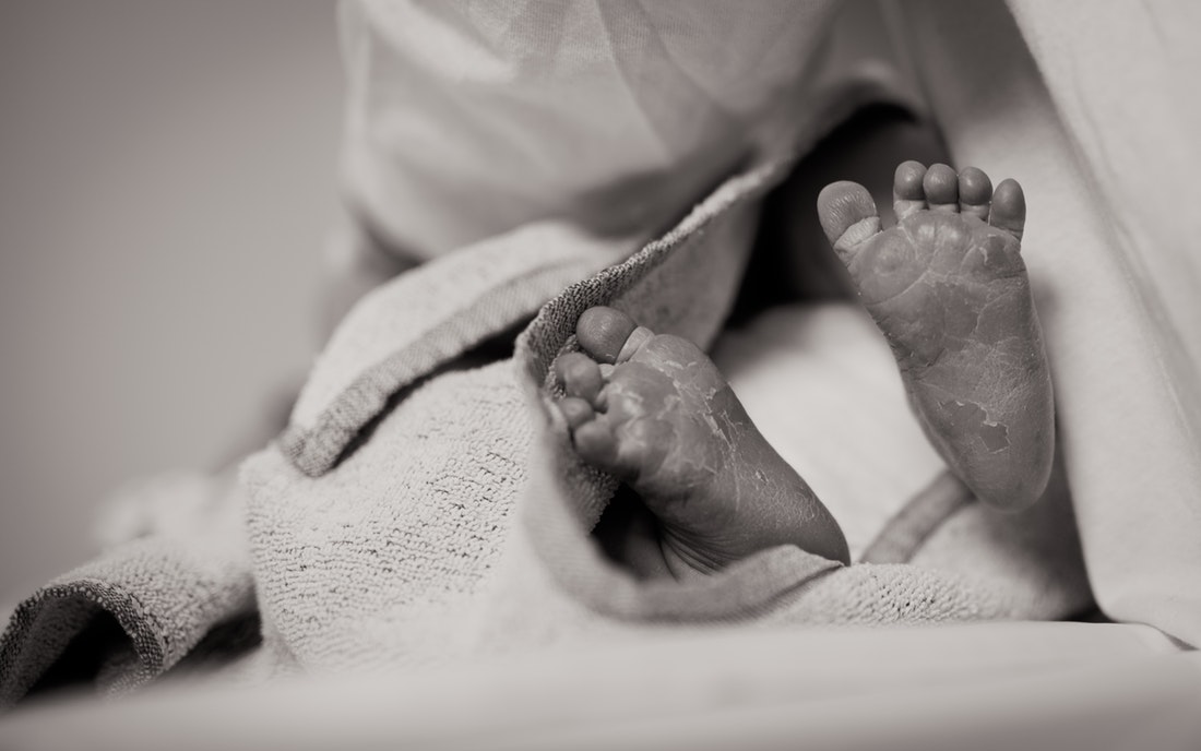 Newborn baby's Feet Upclose | Birth Injuries