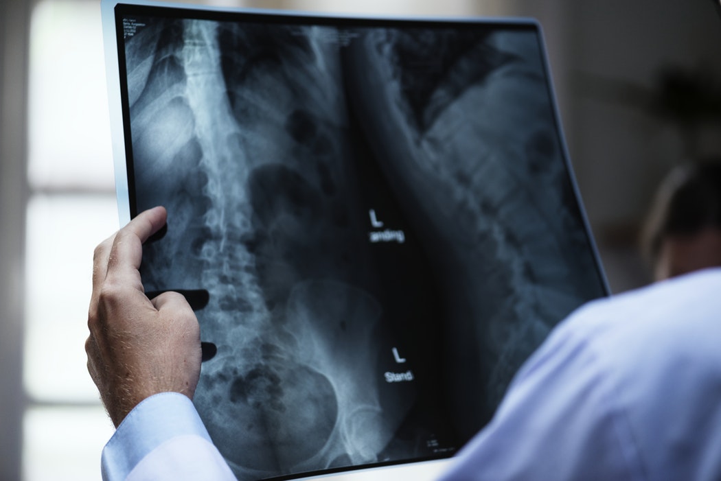 What is hip dysplasia