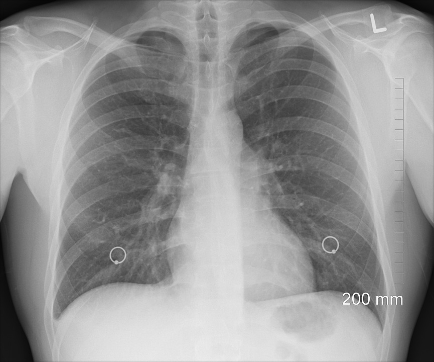 Chest X-ray | Car Accident Claims